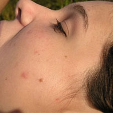 Изчистих кожата си с капките Хепавитал