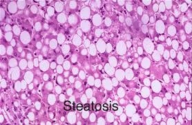 Отслабването – първа стъпка в борбата с мастния черен дроб