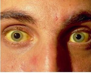 Жълтеница и високи нива на билирубина – каква е връзката?