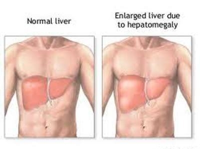 Имах увеличен черен дроб, капките Хепавитал ми помогнаха