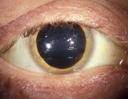 При болест на Уилсън капките Хепавитал са поддържащо лечение